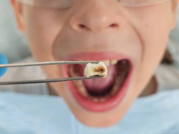 Best Emergency Dentist for Lost Fillings or Crowns in Halawa, HI